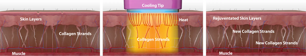 หลักการทำงานของ Thermage 