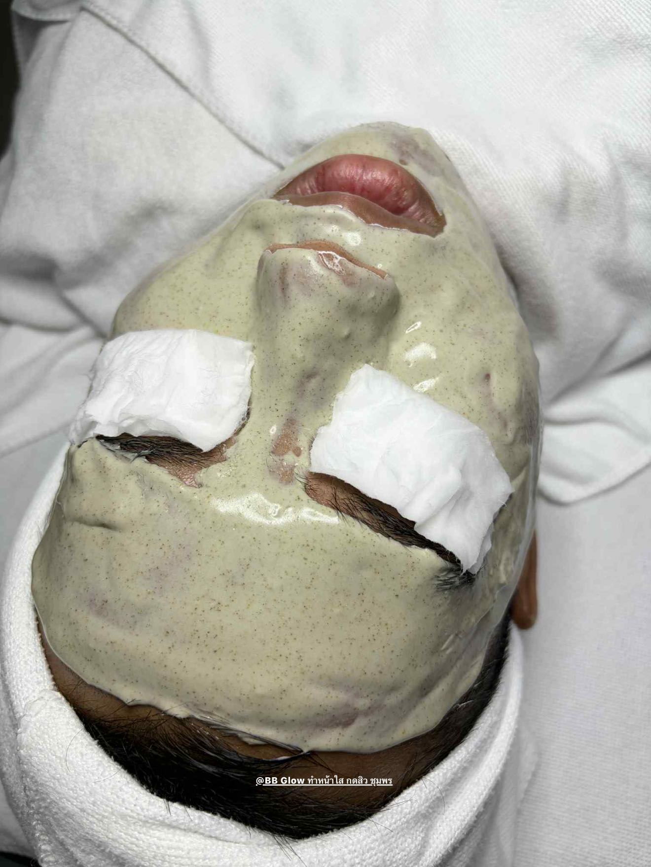 กดสิว ผิวแพ้ง่าย รีวิวจริง ชุมพร