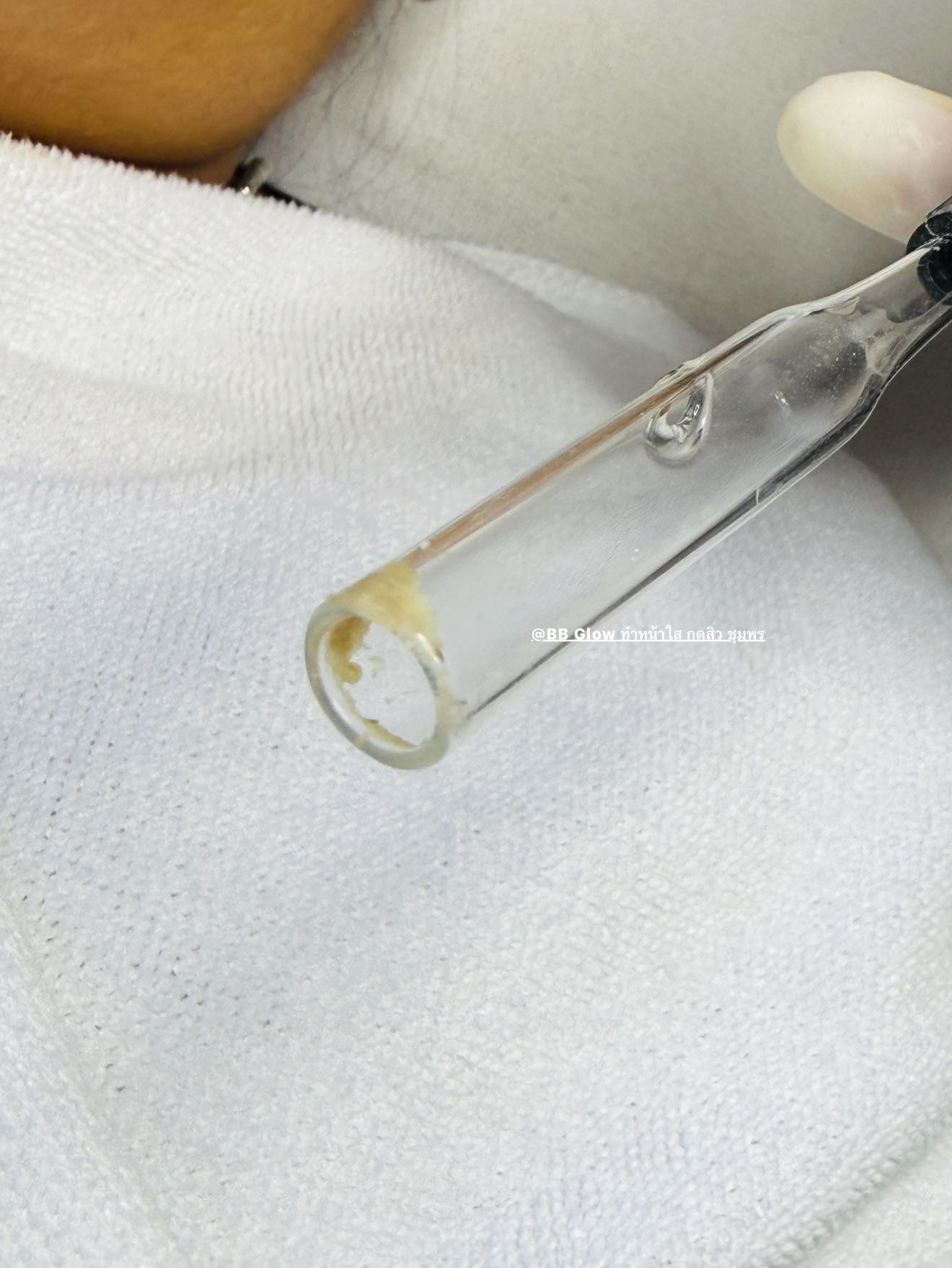 ทรีตเมนต์หน้าใส รูขุมขนกว้าง ชุมพร