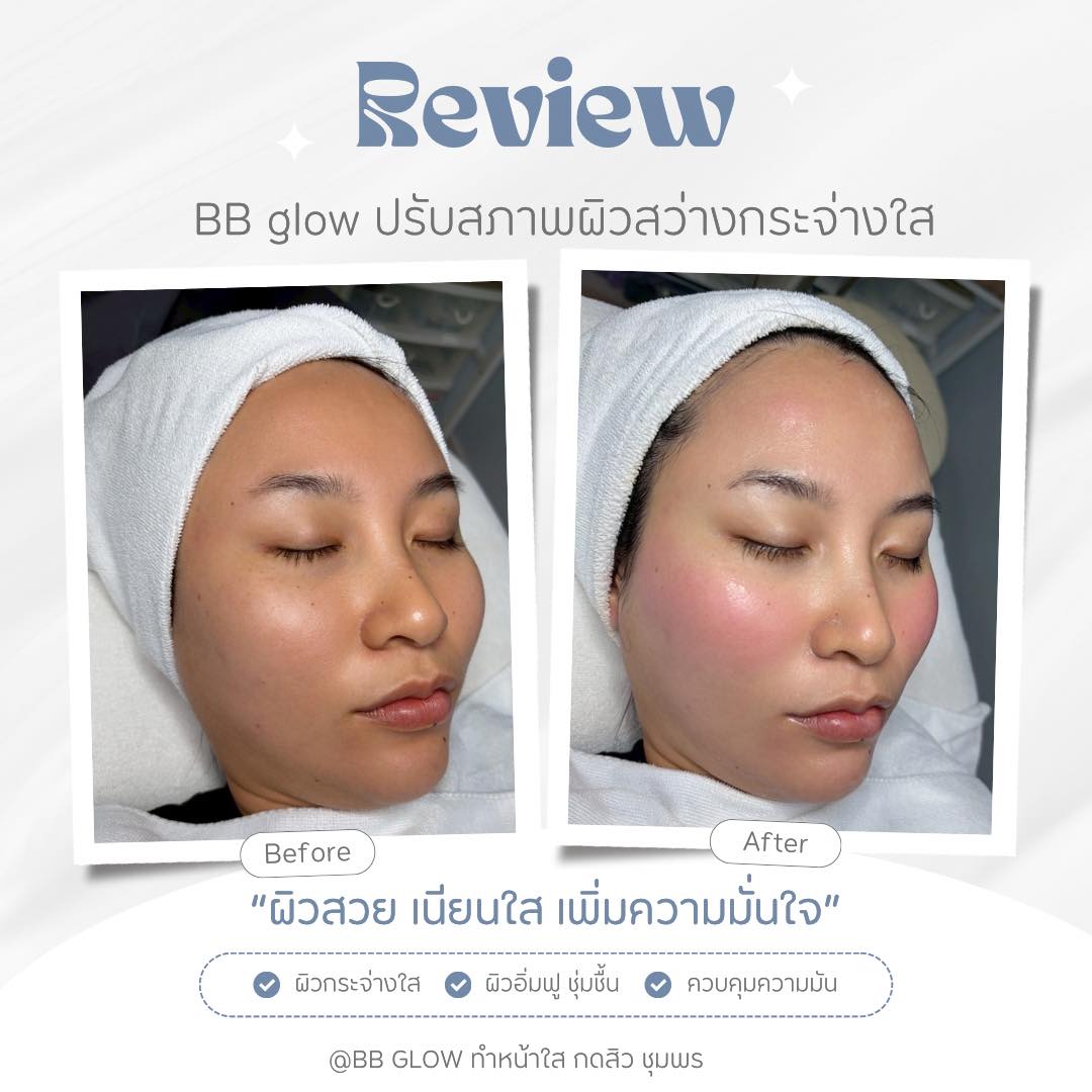 กดสิวลดอุดตัน รีวิว ชุมพร