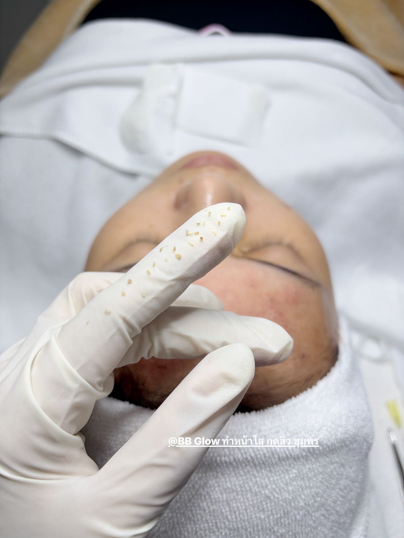 BB Glow ทำหน้าใส รีวิวลูกค้า ชุมพร