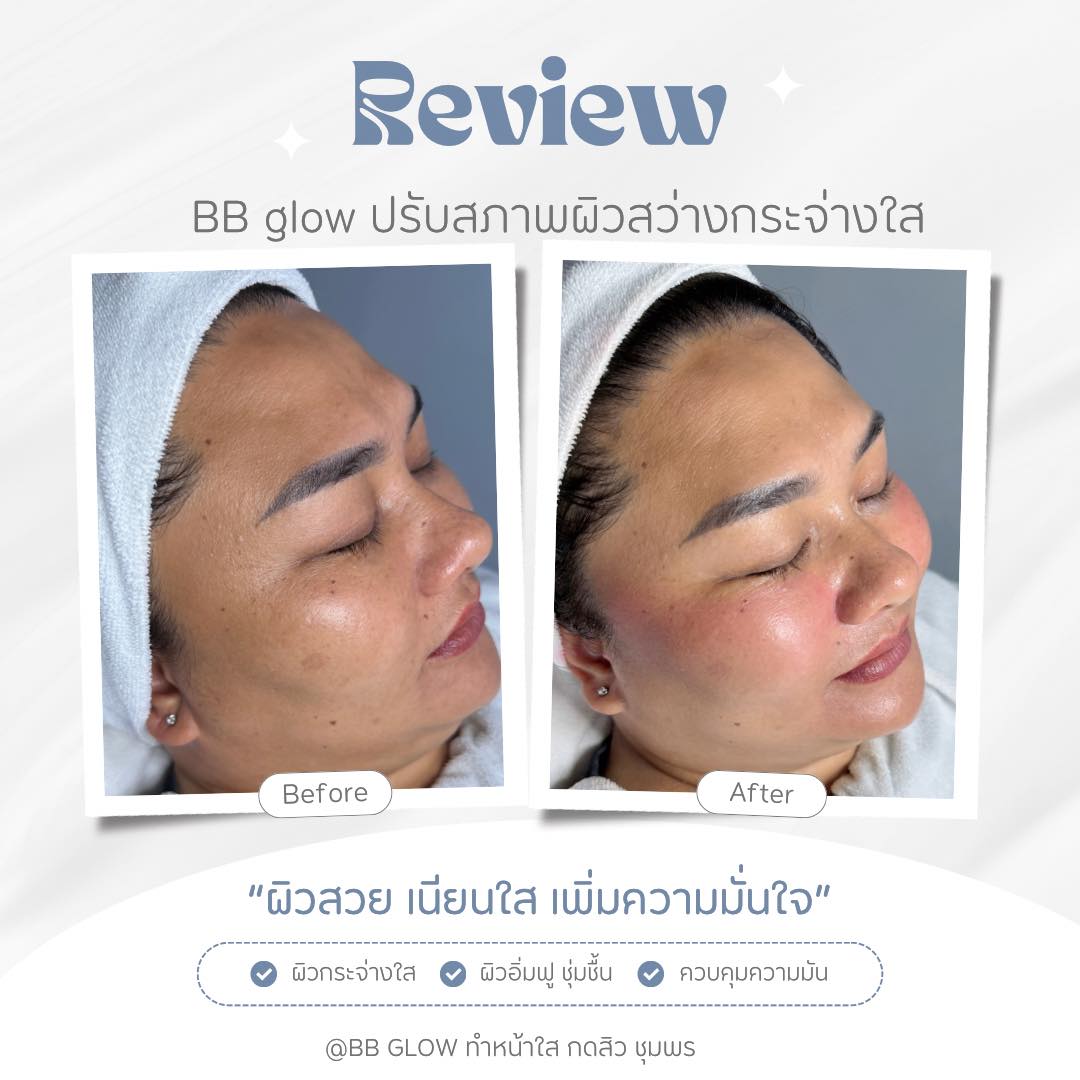 ทรีตเมนต์แก้มชมพู รีวิว ชุมพร