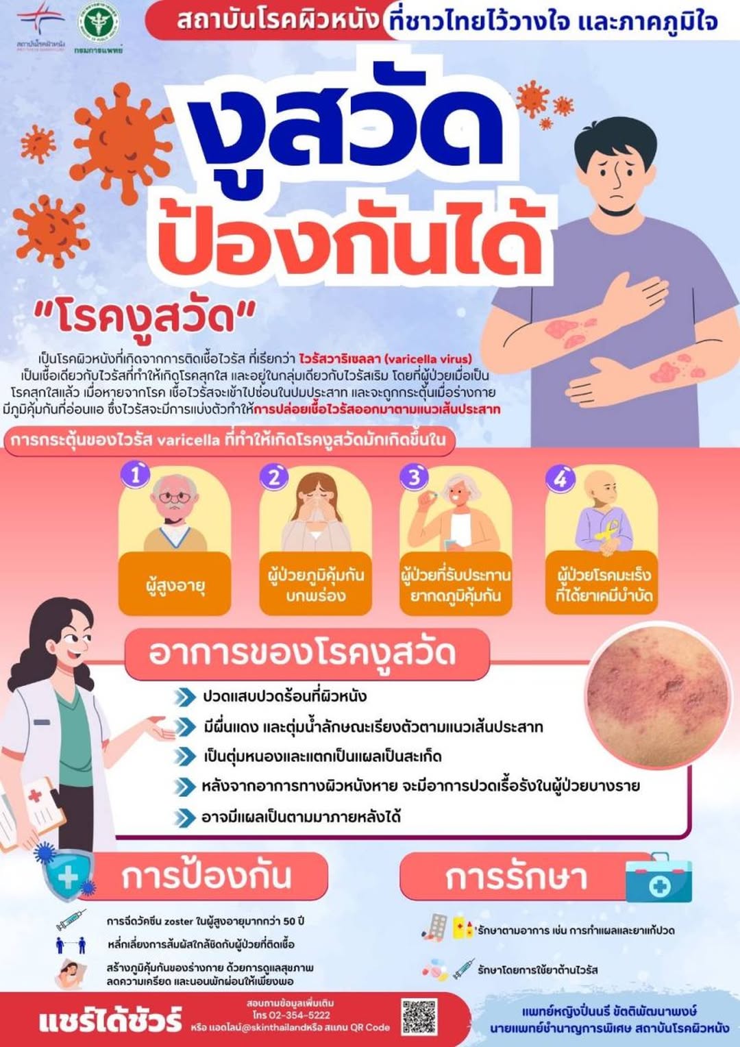โรคงูสวัด