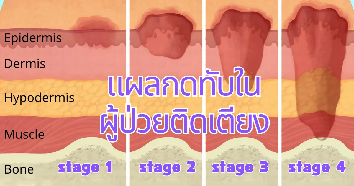 แผลกดทับในระยะต่าง ๆ