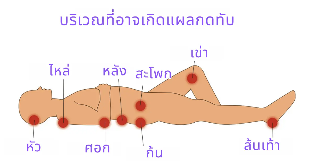 บริเวณที่อาจเกิดแผลกดทับ