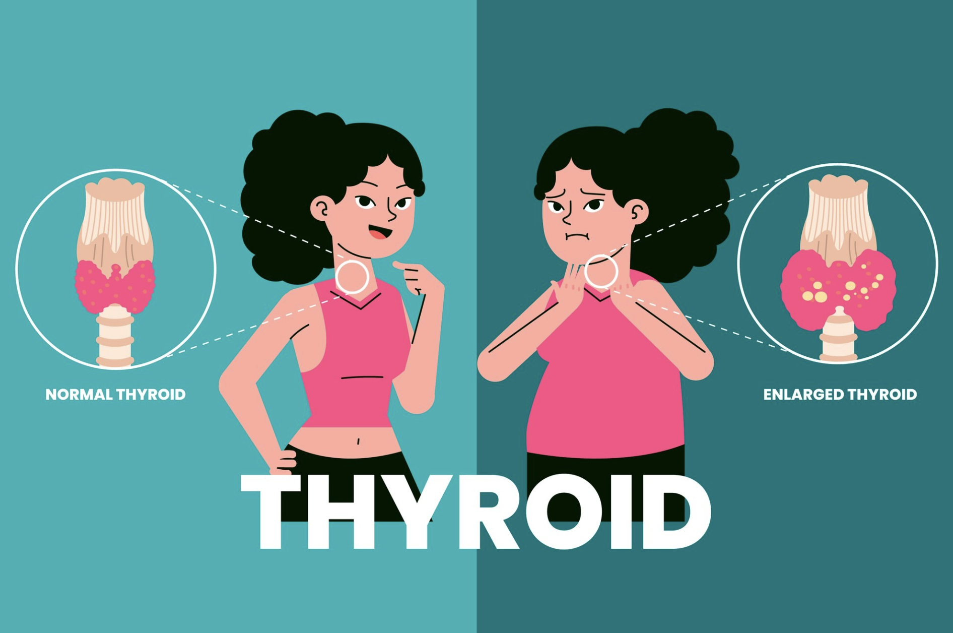 ไทรอยด์เป็นพิษ สาเหตุ