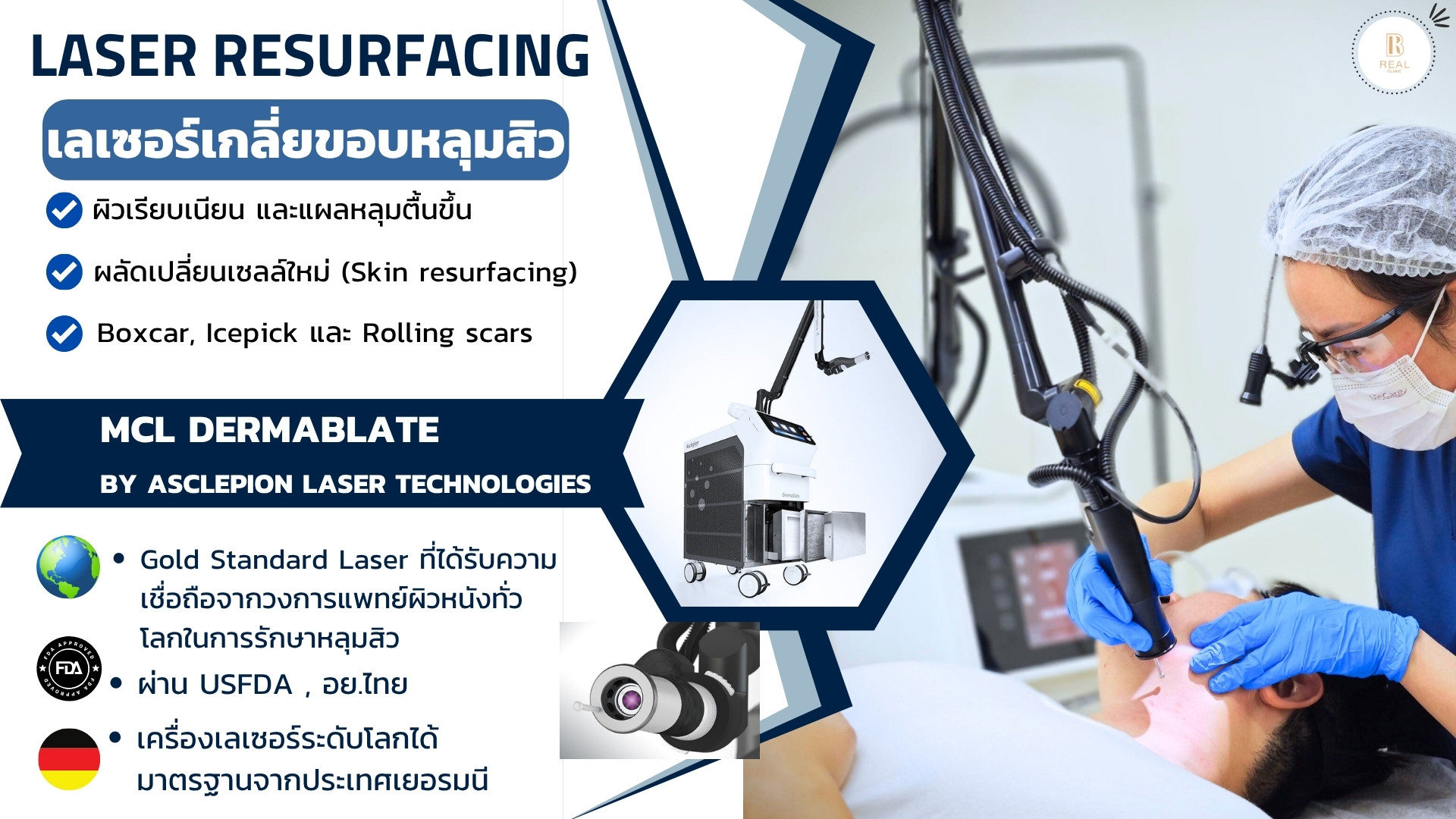 Laser Resurfacing