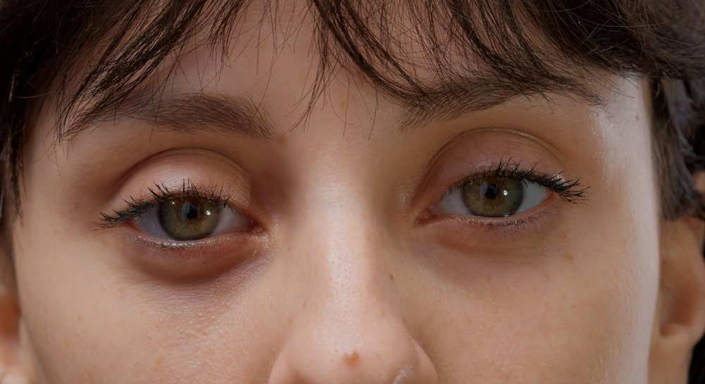 สาเหตุของกล้ามเนื้อตาอ่อนแรง